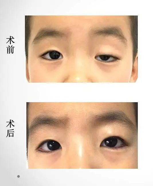 目前由她实施的颅缝早闭患儿手术已达112例,她非常喜欢和孩子们打交道