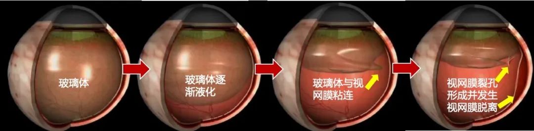 眼前有黑影你可能得了视网膜脱离