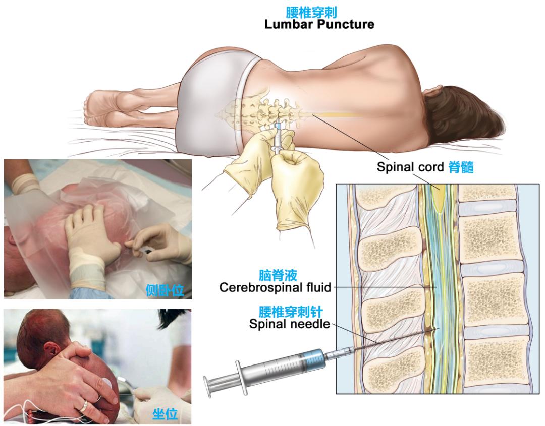 图片摘自网络小知识 腰椎穿刺的体位腰穿不仅可选择侧卧位