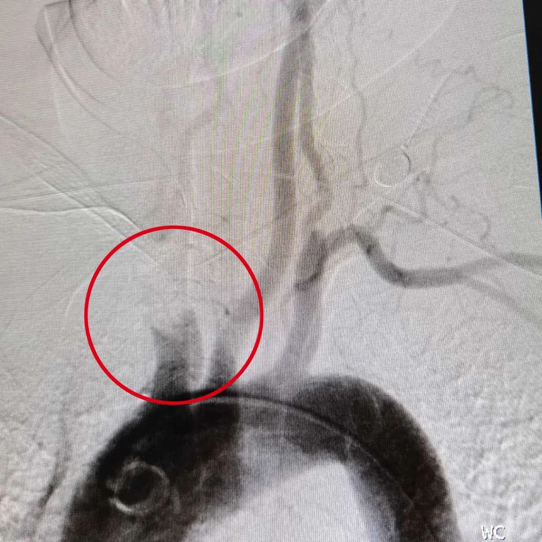 我院成功開展首例顱內動脈栓塞取栓術為患者打開生命通道