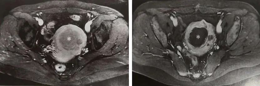 粘膜下子宫肌瘤治疗前后磁共振对比图片，可以明显看到肌瘤被消融“变黑”。