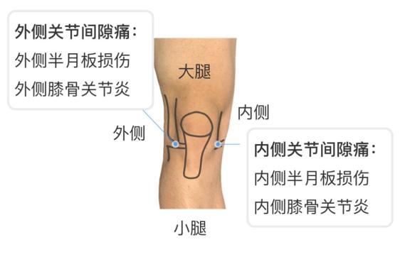 膝盖疼是什么病 一个动作就能判断