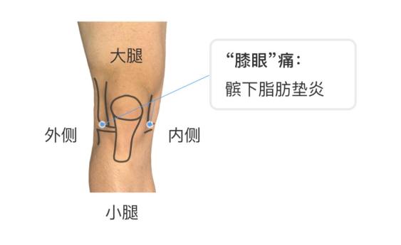 膝盖疼是什么病 一个动作就能判断