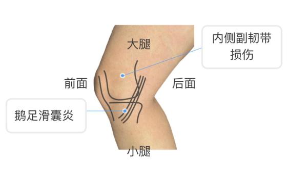 膝盖内侧疼痛怎么回事图片