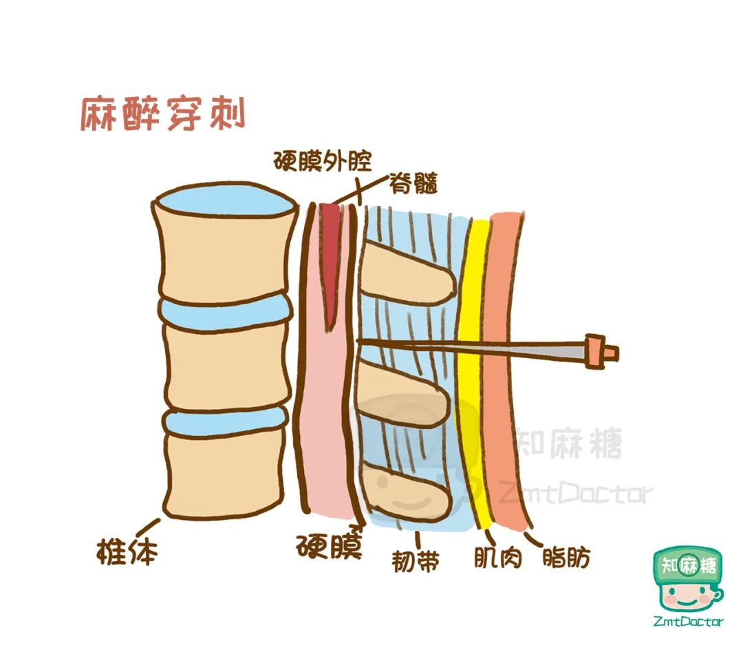 那种打了就半身不遂的麻醉