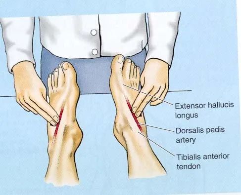 这个叫踝肱指数(abi)测定:通过测量踝部胫后动脉或胫前动脉以及肱动脉