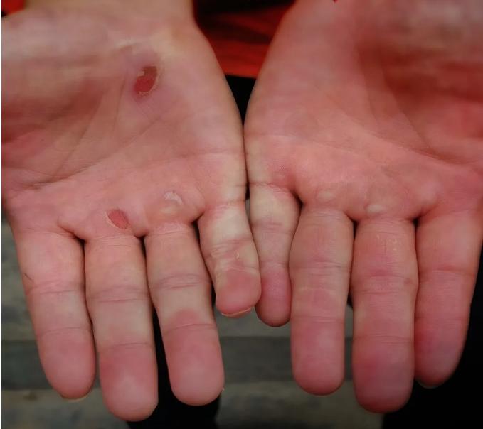 抗洪战士受伤的手图片