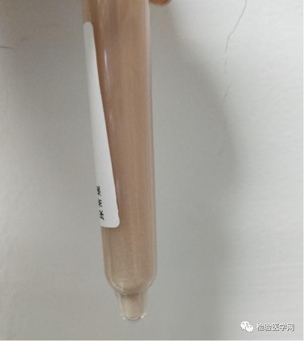 我接过来一看,哎呦,这份尿标本肯定不简单,如图片所见,该份尿液标本