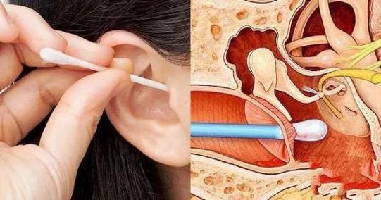 掏耳朵时不注意险丧命医生提醒耳朵这样掏很危险