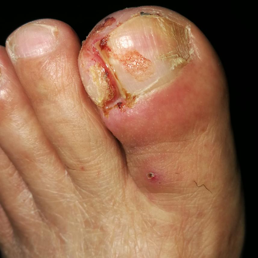足踇趾为好发部位,表现为趾甲周皮肤局部红肿,常伴化脓性肉芽肿改变