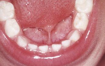 新生儿舌系带短的图片图片