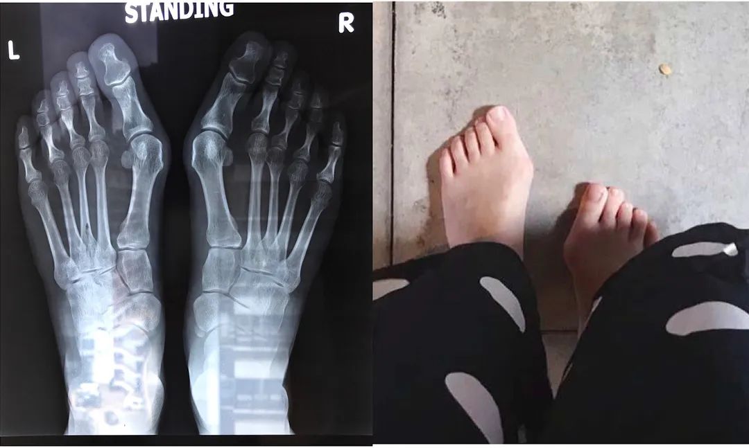 为了能穿夹脚凉鞋 能正常走路 我的脚得挨一刀