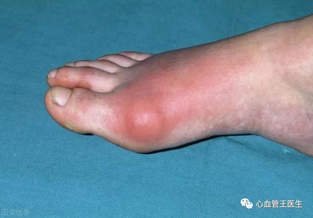 小伙子没吃海鲜没喝啤酒为何却痛风了