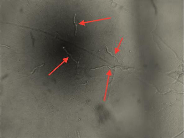 在荧光背景下即使是少量真菌菌丝,孢子也清晰可见,与传统koh湿片法