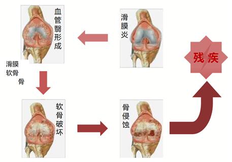 类风湿关节炎(ra)是一种病因未明的慢性,以炎性滑膜炎为主的系统性