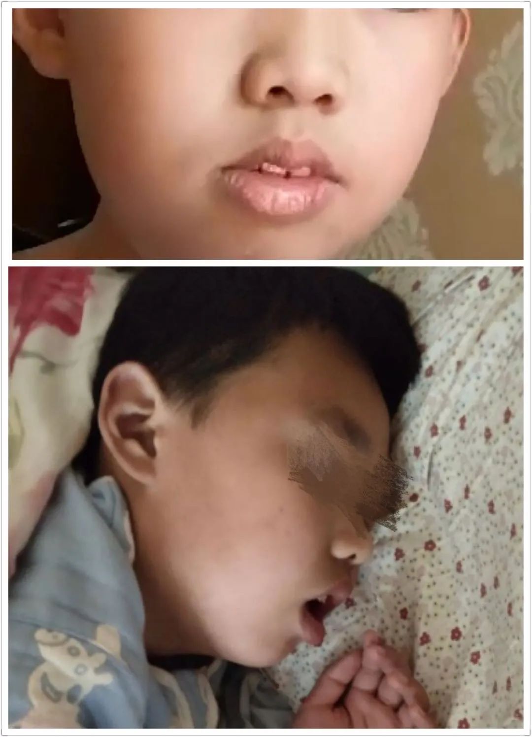 腺样体手术后为何孩子仍打呼张嘴呼吸黑眼圈严重