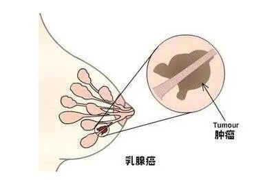 粉红丝带胸部的肿块不疼就没事了大错特错