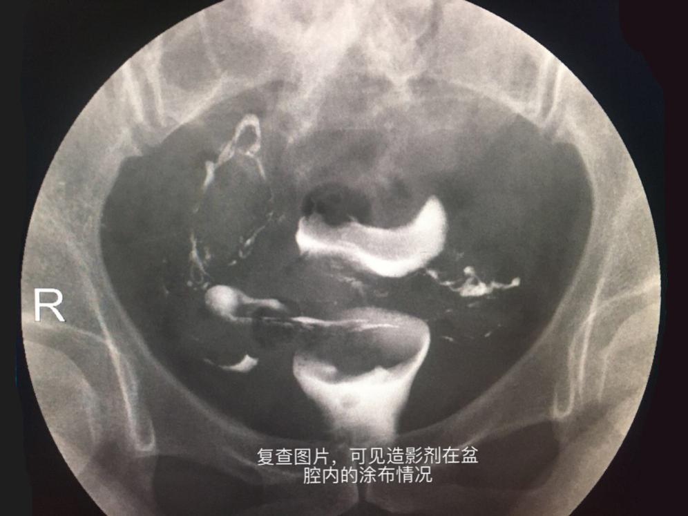 給生命之路照個相輸卵管造影術