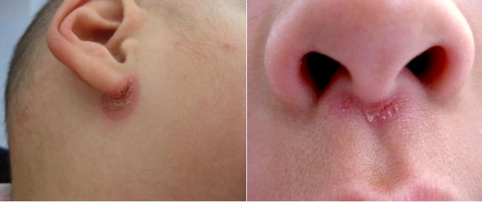 宝贝健康宝典四关于儿童湿疹您关心的都在这里