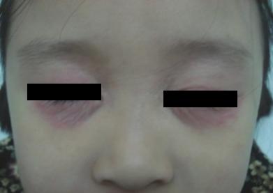 宝贝健康宝典四关于儿童湿疹您关心的都在这里