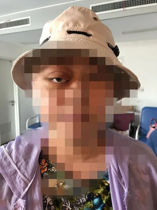 颅骨纤维异常增生 长兴女子长了一只"乒乓球眼"