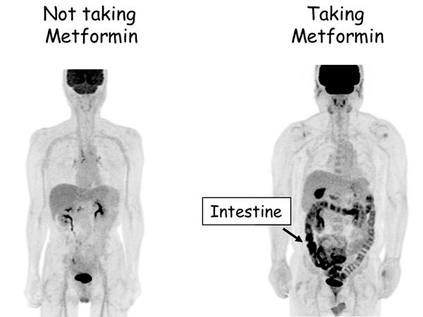 科学家首次发现 二甲双胍竟然会促进肠道将血糖排到粪便中 湃客 澎湃新闻 The Paper