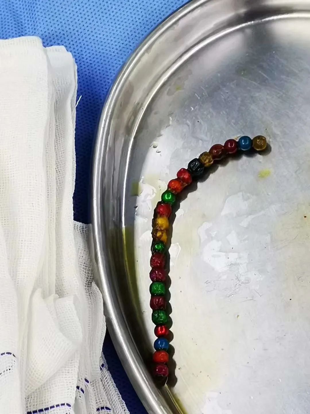 小心这种玩具3岁男童小肠8处穿孔