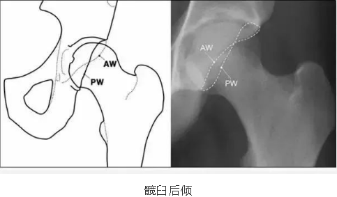 髋关节盂唇损伤髋臼盂唇是纤维软骨结构,包饶在髋臼周围,止于髋臼横