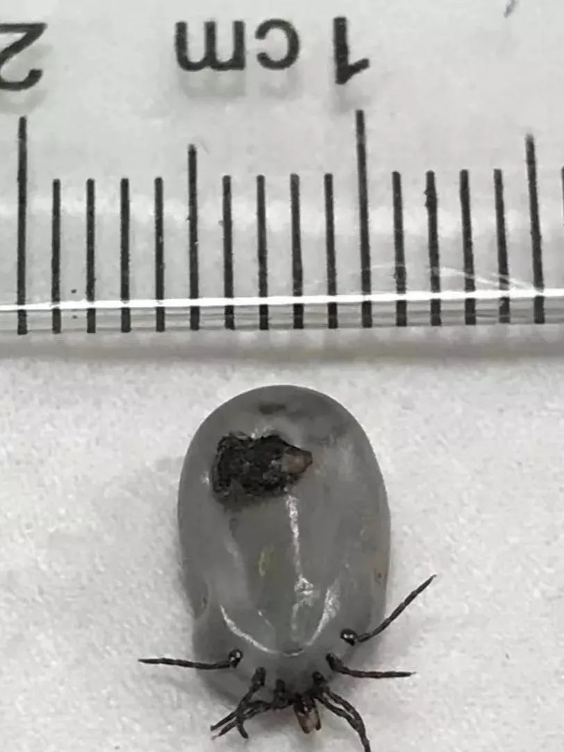 孩子耳朵疼痛近一个月医生竟在耳朵里取出一只蜱虫