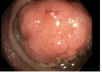 胃镜示:肥厚性(草莓状)胃肠炎和十二指肠球炎(图2),结肠镜示:从盲肠到