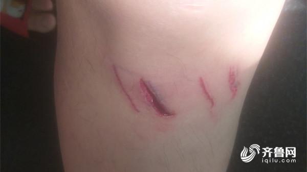 缝了8针误工半月…济南男子泳池受伤索赔遭拒,商家:我的损失比他大