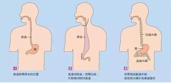 目前術後比較常見的併發症,包括:肺部感染,肺不張,ards:患者術後出現