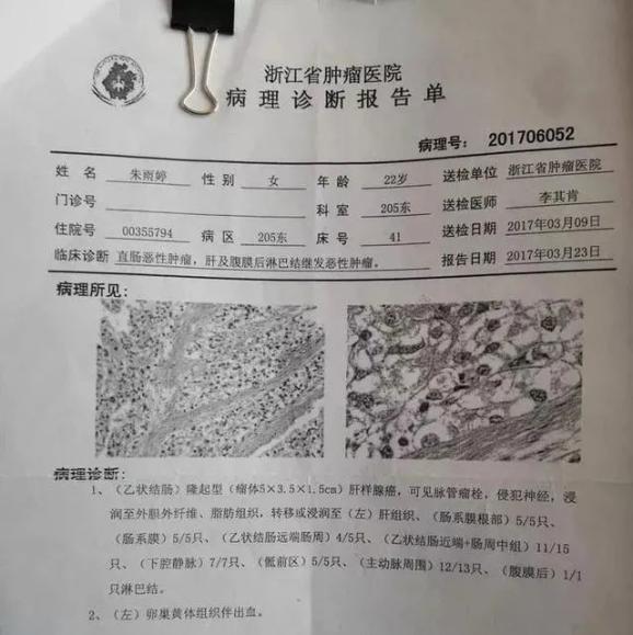 抗癌两年多25岁的姑娘还是走了她给世界留下一双眼睛