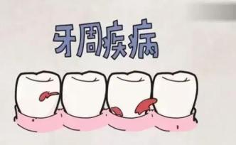 刷一次牙满口血，牙周病为何磨牙又磨人？