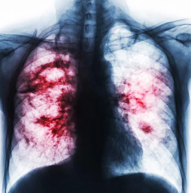 新冠肺炎的肺部图片图片