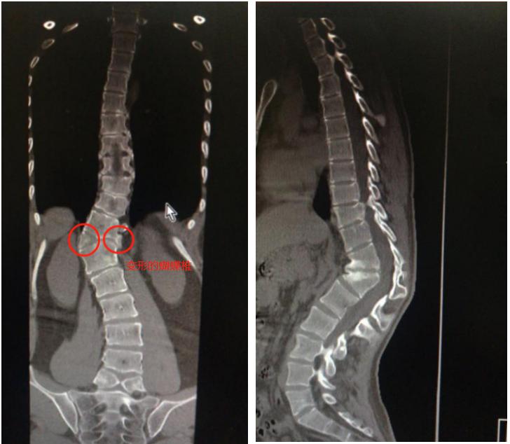 小李的情况属于前侧和中部椎体形成障碍所致蝴蝶椎,这类畸形病情进展