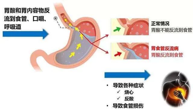 哪些不良习惯会加重反酸烧心发作