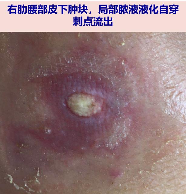 探案丨肺部空洞腰部流脓青年男性何去何从