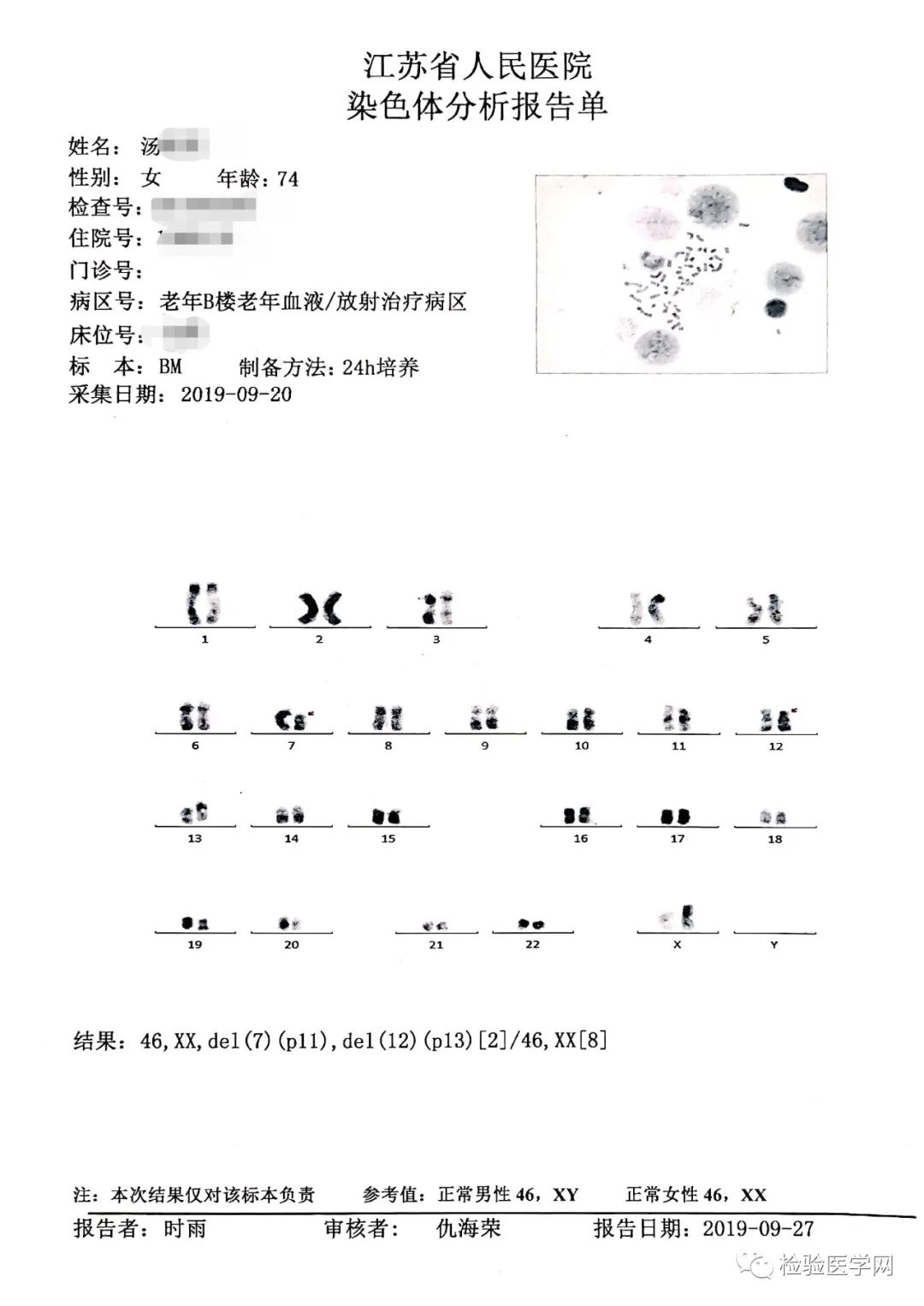 血液系统疾病诊断思路图解病例之类似burkitt淋巴瘤的all 湃客 澎湃新闻 The Paper