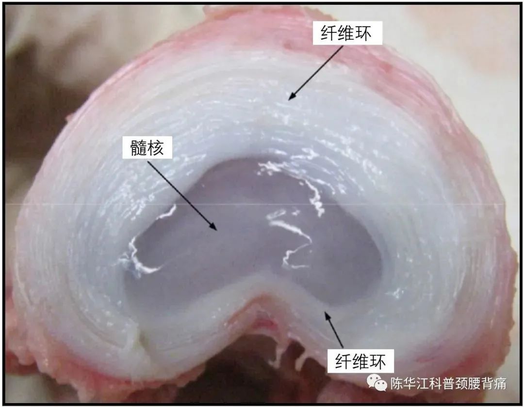 椎间盘突出 一个破坏了封印的悲伤故事