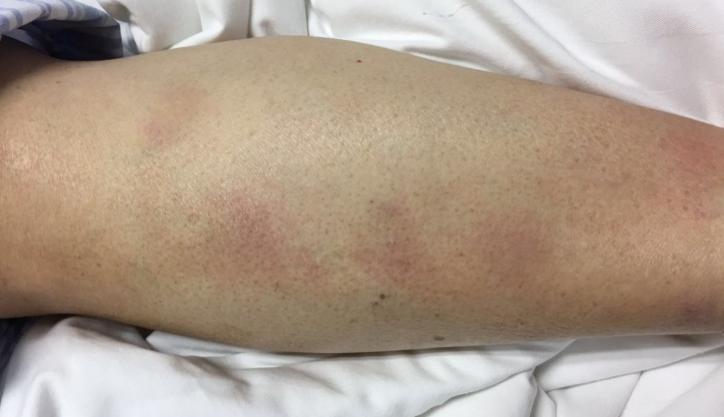 吃了顿小龙虾后反复发热辗转20天才找到原因风榜定案