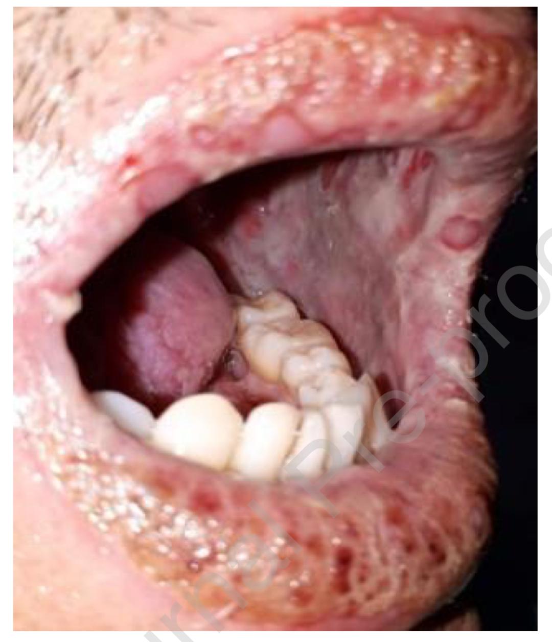 病例分享免疫治疗引起严重口腔黏膜炎