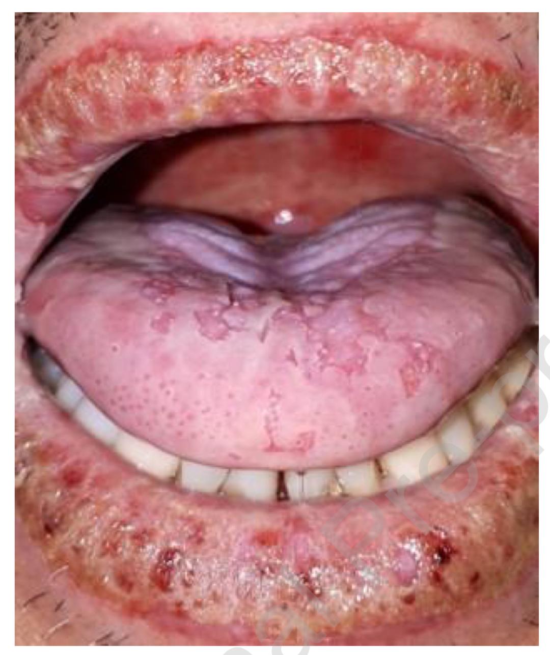 口腔粘膜炎的症状图片图片
