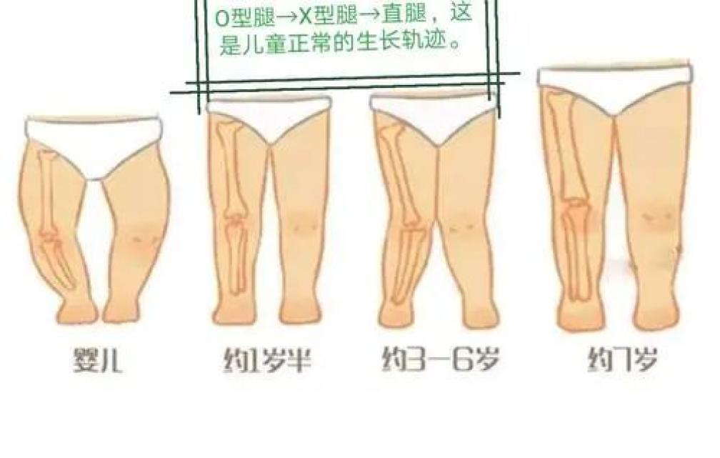 不能说明缺钙,也不是纸尿裤勒的……而是宝宝腿型发育过程中的阶段性