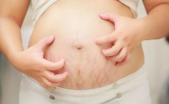一孕丑三年？如何预防孕期妊娠纹的出现？