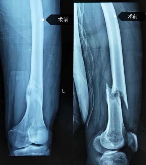 甲状腺肿瘤相对于其它肿瘤来说生存期比较长,而且考虑到患者还年轻