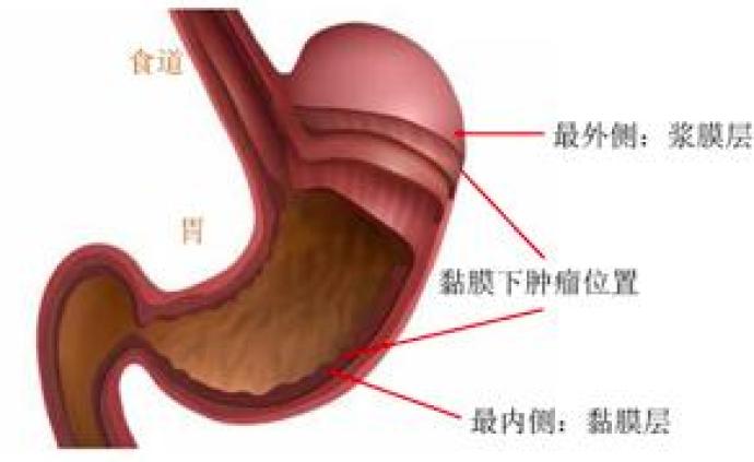 胃黏膜下肿瘤的治疗