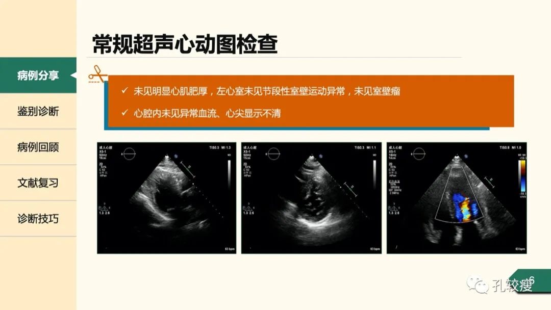 t波深倒置的鑑別診斷從心電圖到超聲