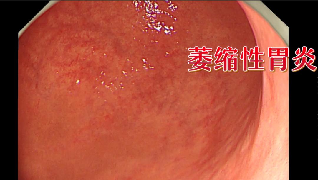 早期胃癌究竟有没有特异性症状
