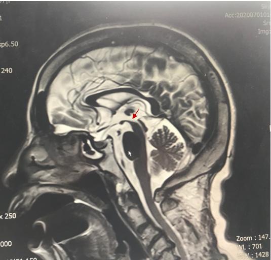 中脑被盖部有萎缩,红色箭头所示 患者头颅磁共振没有典型psp影像